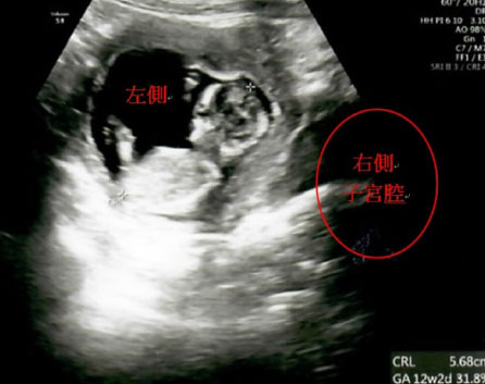 胎兒在產婦右側子宮腔內著床發育