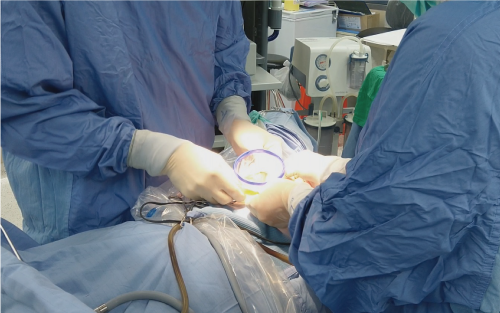 3D腹腔鏡腫瘤切除手術2