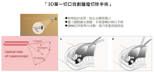 3D腹腔鏡腫瘤切除手術
