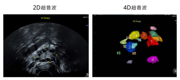 2D超音波與4D超音波檢查的不同
