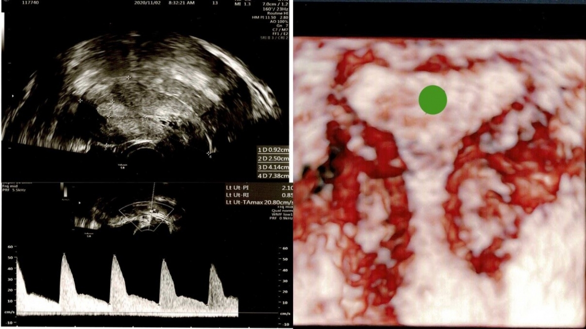 4D超音波案例分享：T型子宮