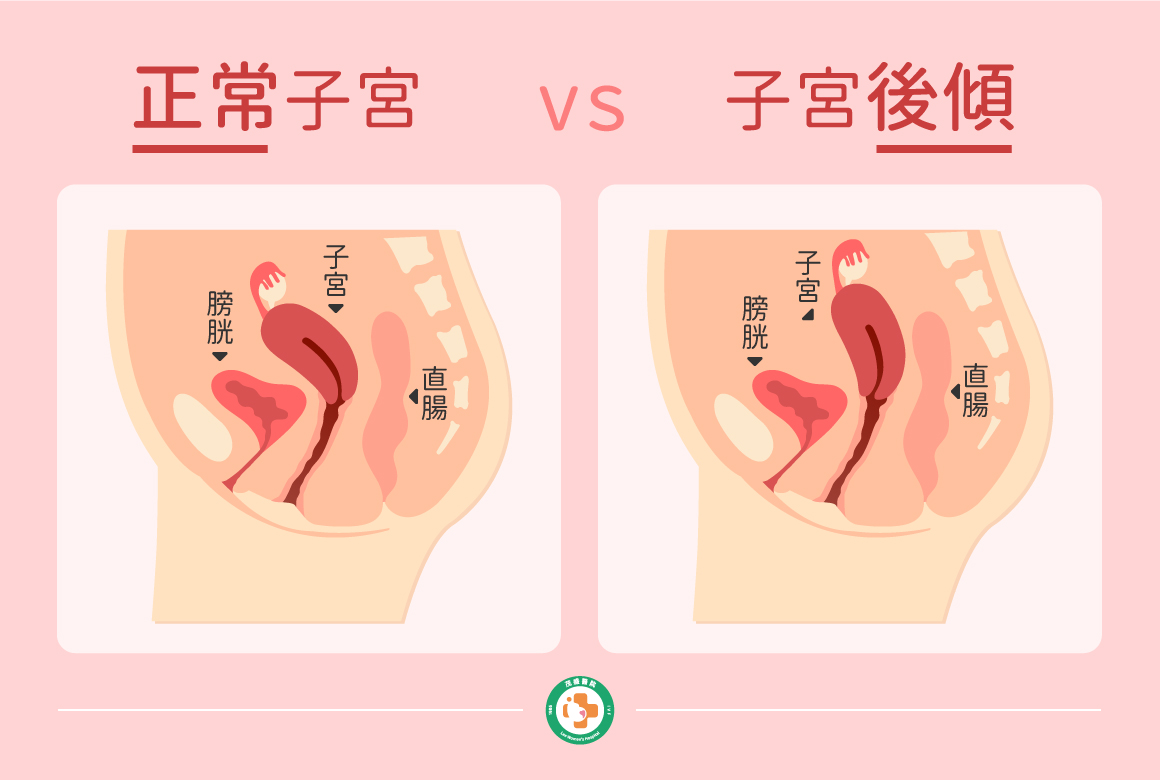 子宮後傾和正常子宮比較圖