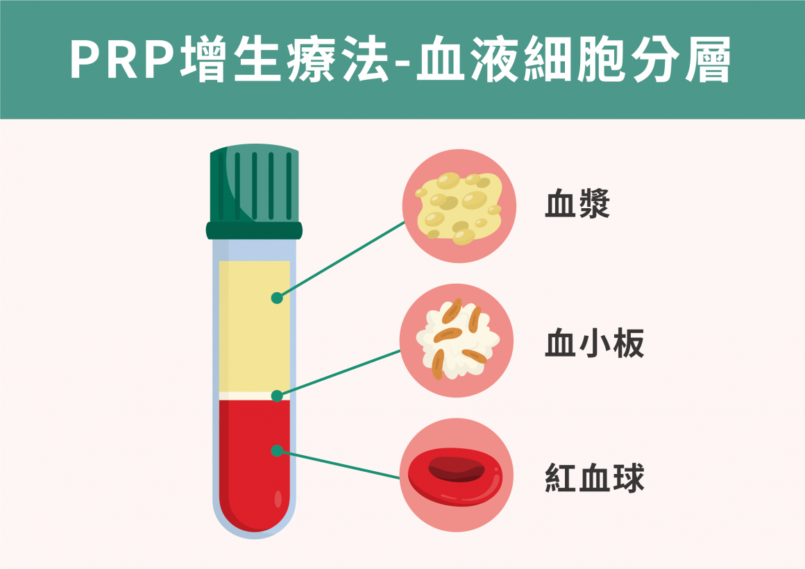 PRP療法-血液細胞分層