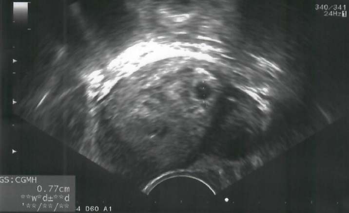 胚胎超音波