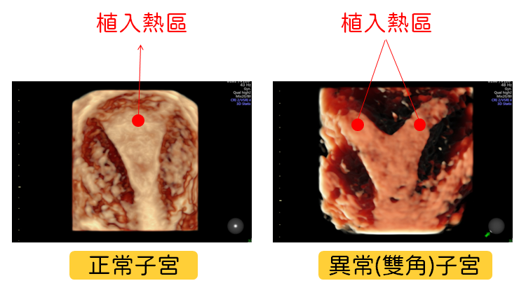 4D 超音波图：帮助医师能精准判断胚胎植入最佳位置