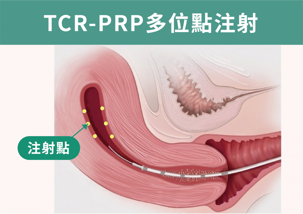 TCP-PRP多位點注射 TCP-PRP多位點注射