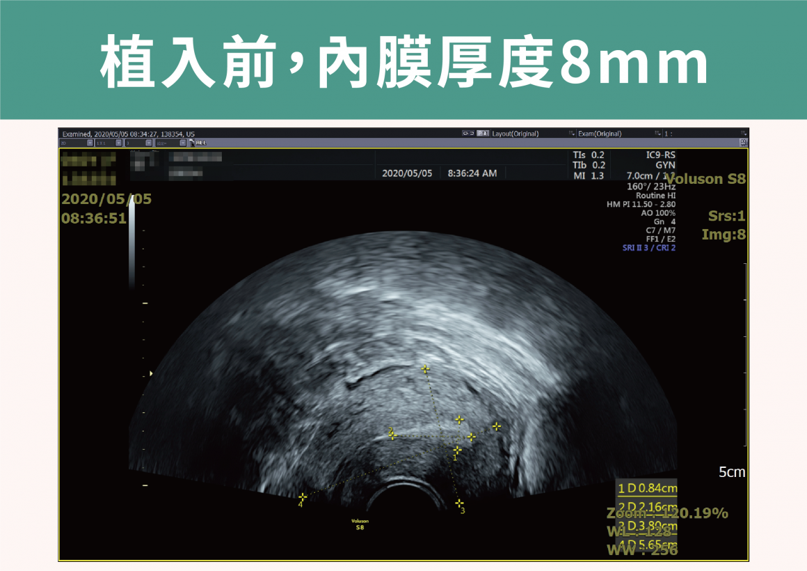 案例分享:治療後,內膜厚度8mm 案例分享:治療後,內膜厚度8mm