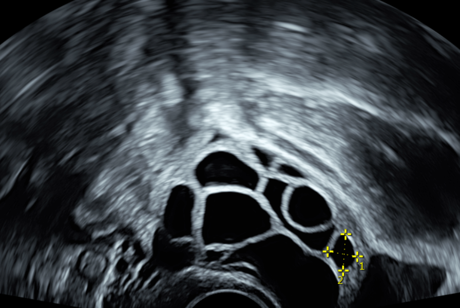 161553徐凱希_陰道超音波_裁切檔 161553徐凱希_陰道超音波_裁切檔