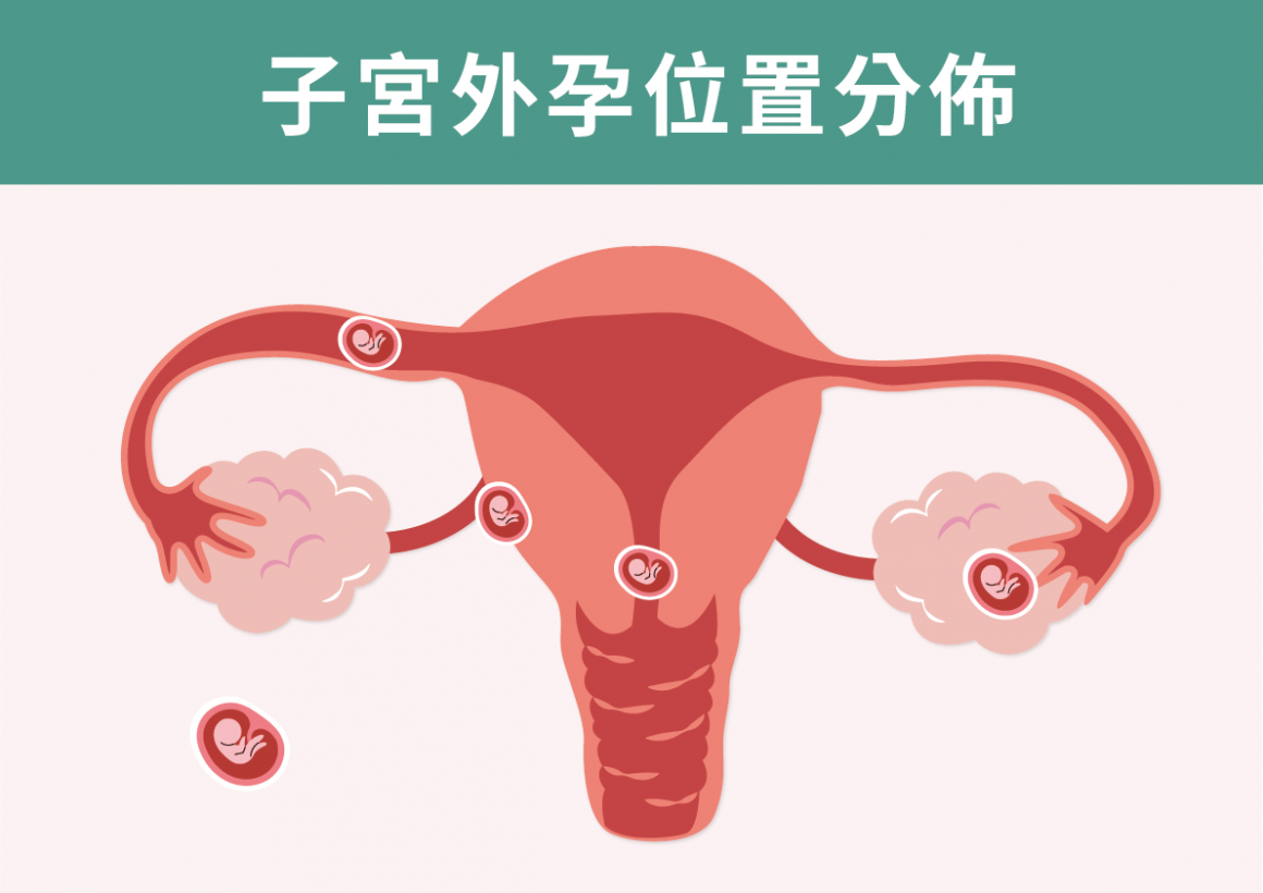 子宮外孕位置分佈