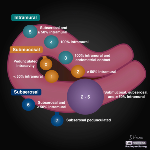 uterine-leiomyoma-fibroid-classification-system-illustration uterine-leiomyoma-fibroid-classification-system-illustration